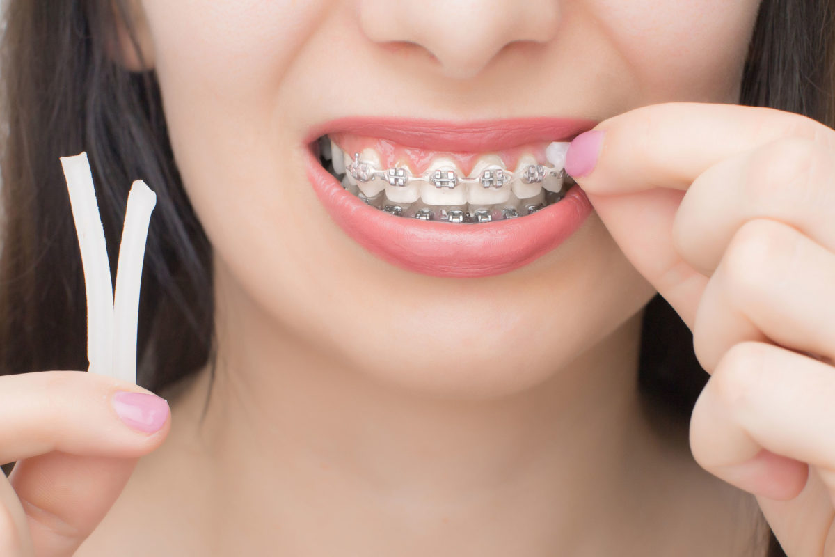 Gãy răng cửa có ảnh hưởng gì không? phải làm sao để khắc phục