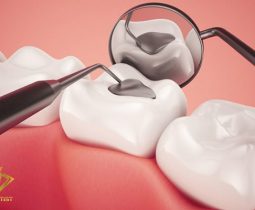 Trám răng – Khôi phục tình trạng răng ban đầu