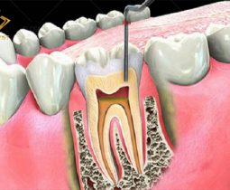 Điều trị tuỷ răng – Bảo tồn răng gốc tối đa