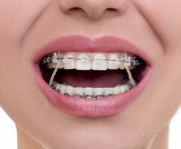 Chuyên gia giải đáp: Niềng răng có đau không?