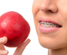 Niềng răng có khó ăn không? Sau khi niềng răng cần chế độ ăn uống phù hợp như thế nào?
