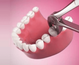 Niềng răng có nhổ răng không – Những ảnh hưởng của việc nhổ răng khi niềng?