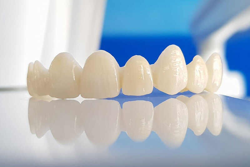 Dán răng sứ Veneer Phương pháp phục hình hiệu quả và có tính thẩm mỹ cao