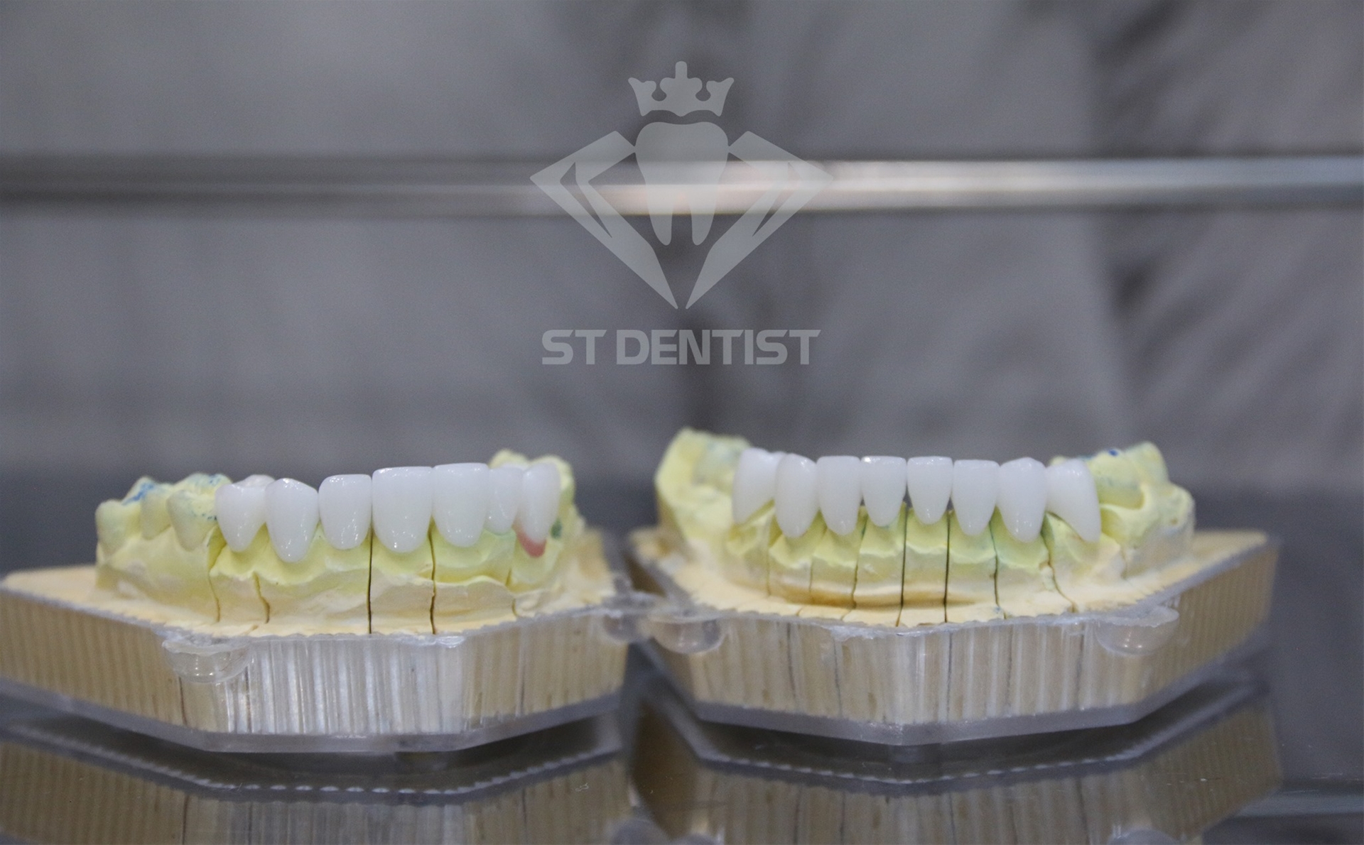 Mẫu răng sứ tại ST Dentist
