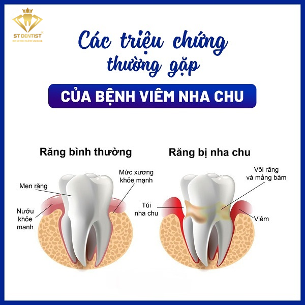 Biến Chứng Viêm Nha Chu: Nguy Cơ và Cách Phòng Tránh