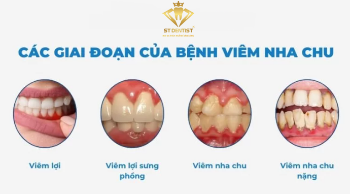 giai-doan-benh-viem-nha-chu