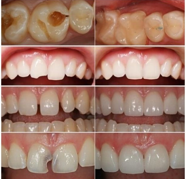 Các trường hợp  có thể bọc răng sứ Zirconia