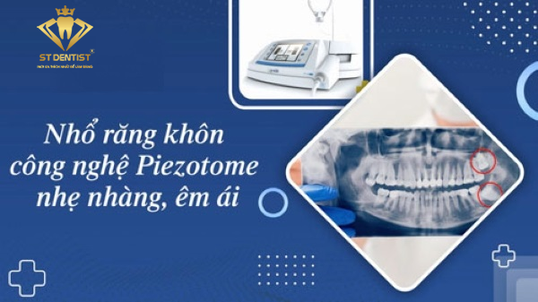 Nhổ Răng Khôn Công Nghệ Piezotome: Giải Pháp An Toàn Và Ít Đau