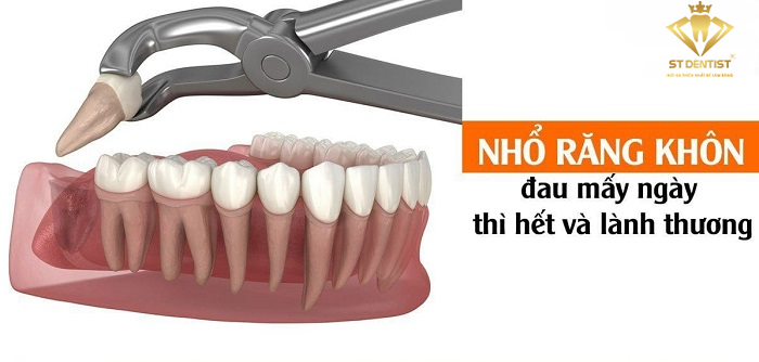 Nhổ Răng Khôn Đau Mấy Ngày Là Hết? Cẩm Nang Cho Bạn