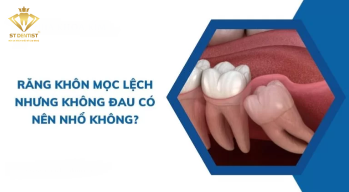 Răng Khôn Mọc Lệch Nhưng Không Đau Có Nên Nhổ?