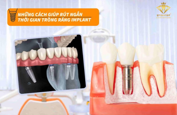 cach-rut-ngan-thoi-gian-trong-implant