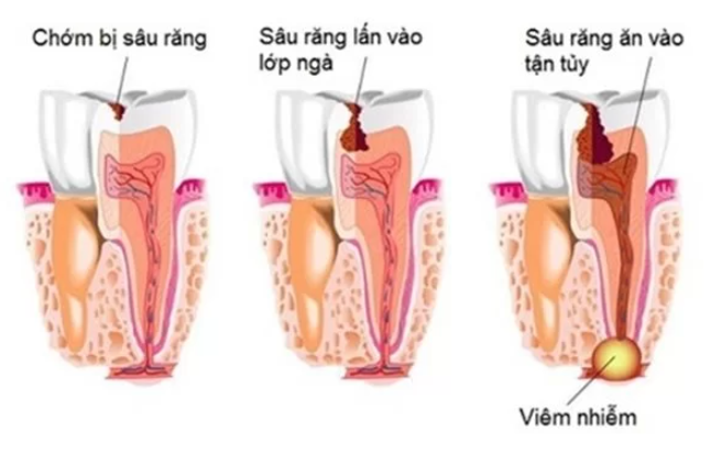 cach-tri-lo-sau-rang-1