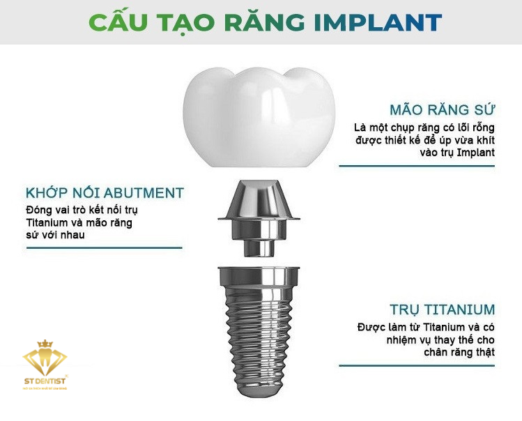 cau-tao-rang-implant