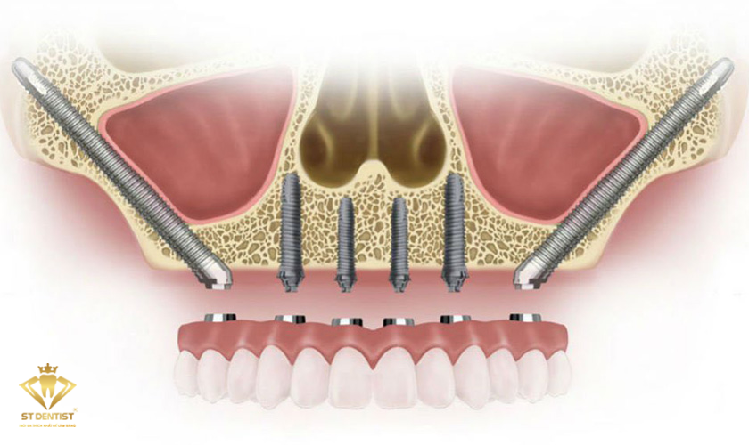 cay-ghep-Implant-xuong-go-ma-1