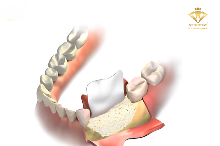 ghep-xuong-implant-2