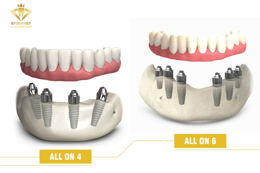 giai-phap-implant-all-on-4-va-6