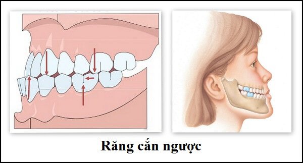 khop-can-nguoc-1