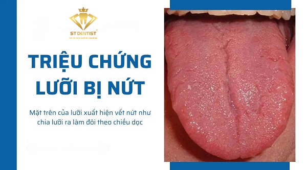 luoi-bi-nut-la-benh-gi-1