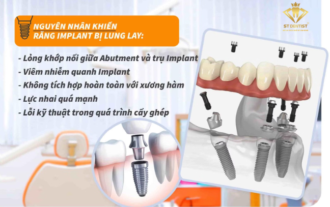 nguyen-nhan-rang-implant-lung-lay