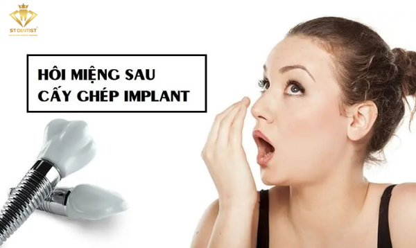 nguyen-nhan-trong-rang-implant-bi-hoi-mieng