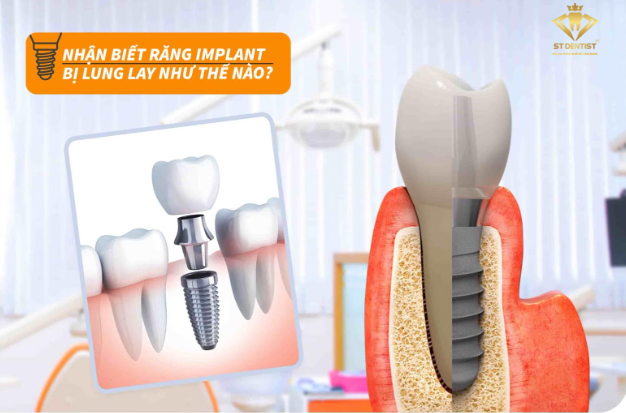 nhan-biet-rang-implant-lung-lay