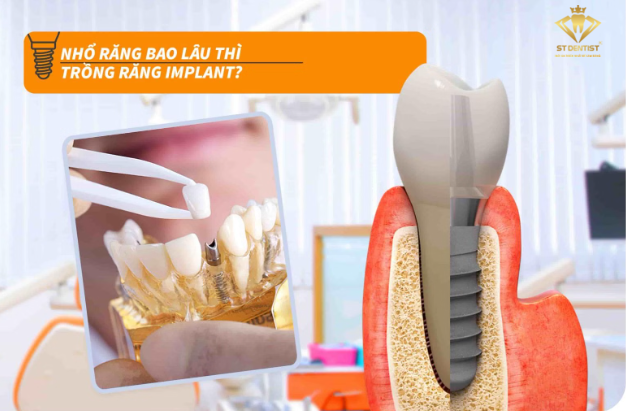 nho-rang-bao-lau-thi-cay-implant-duoc-1