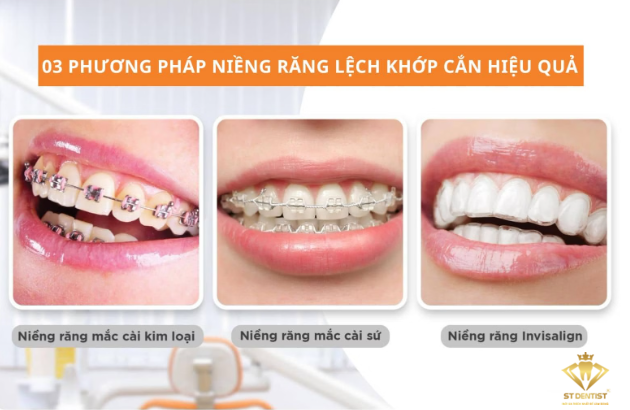 nieng-rang-lech-khop-can-1