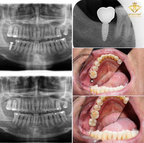 phuc-hinh-rang-su-tren-implant-1