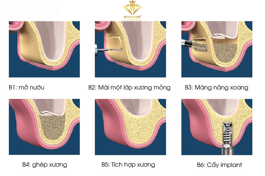 quy-trinh-nang-xoang-ghep-xuong