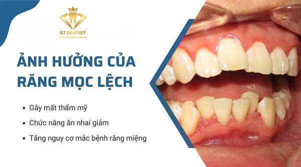 rang-moc-lech-2