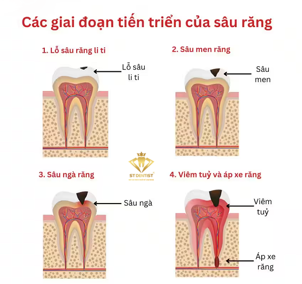 sau-rang-la-gi-4