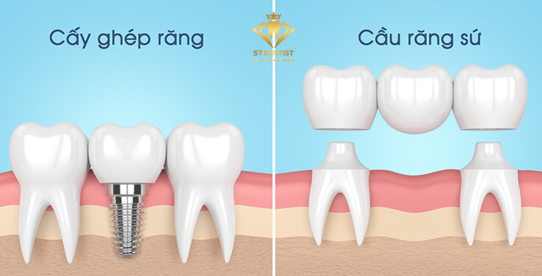 trong-rang-gia-co-dinh-1