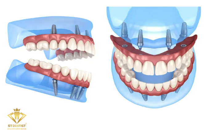 trong-rang-implant-all-on-4-a