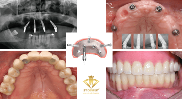 trong-rang-implant-all-on-4-b