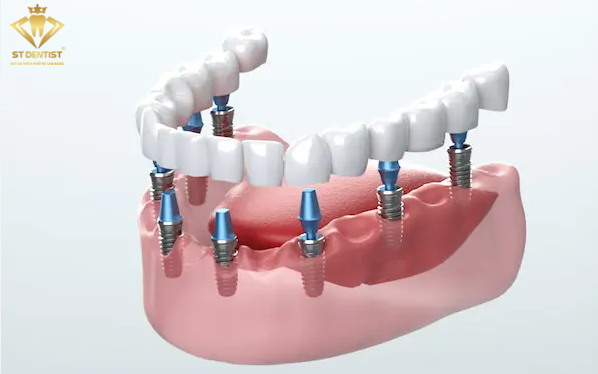 trong-rang-implant-all-on-6-a