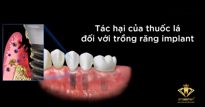 trong-rang-implant-co-duoc-hut-thuoc-khong-1