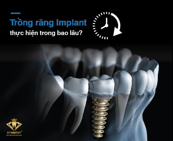 trong-rang-implant-mat-bao-lau-1