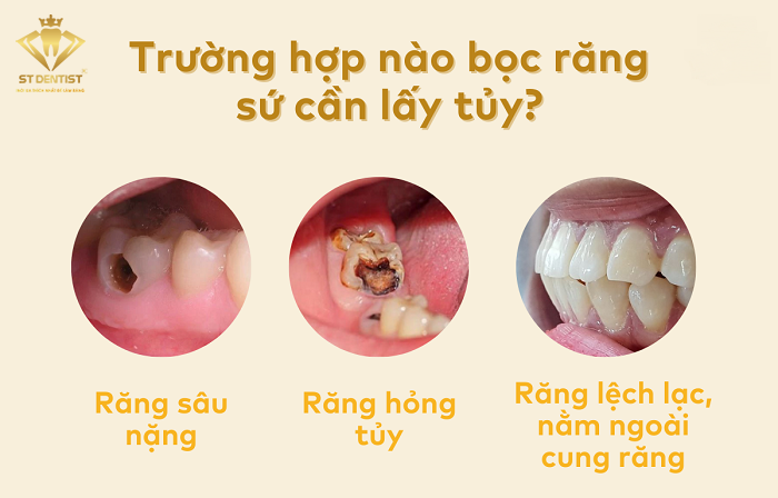 truong-hop-boc-rang-su-lay-tuy