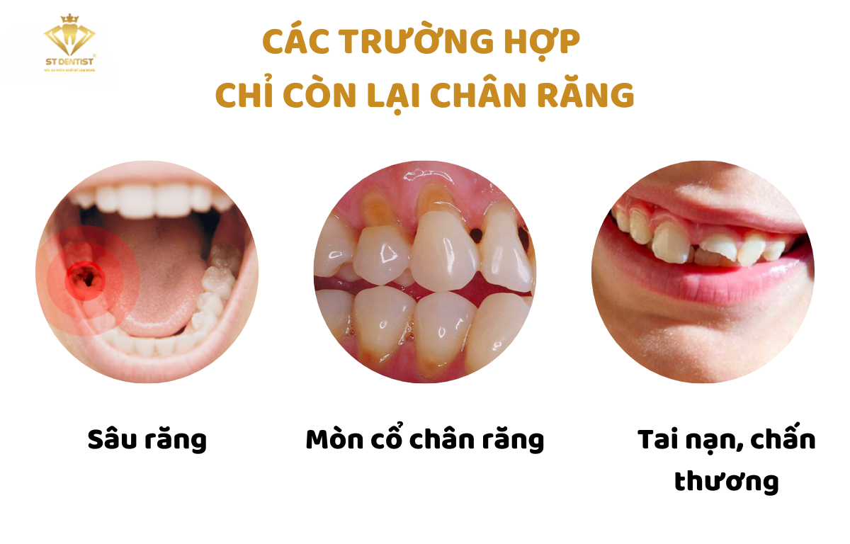 truong-hop-con-chan-rang