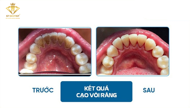 voi-rang-tu-troc-duoc-khong-1