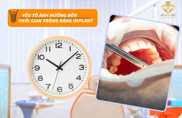 yeu-to-anh-huong-thoi-gian-trong-rang-implant