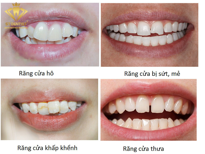 Cách khắc phục răng bị mẻ như thế nào?