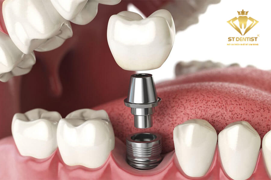 Phương pháp trồng răng implant có đau không