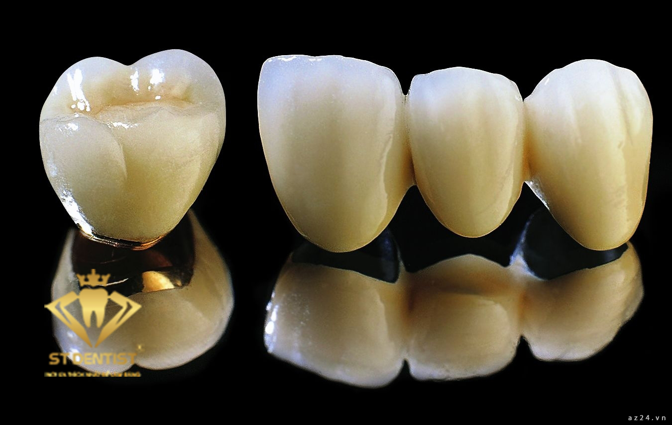 Một số thông tin quan trọng về răng sứ titan mà bạn nên biết