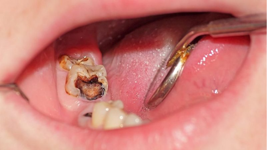 Sâu răng là “tai hoạ” đối với sức khỏe