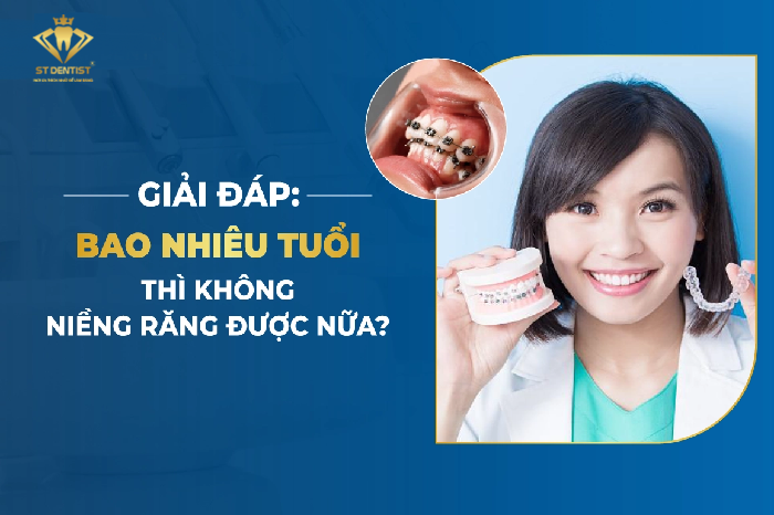 Bao Nhiêu Tuổi Thì Không Niềng Răng Được【Tìm Hiểu】