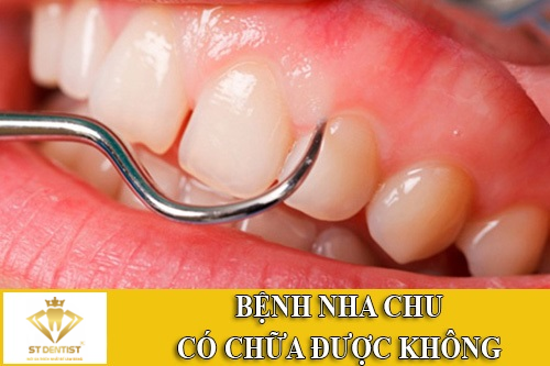 Bệnh Nha Chu Có Chữa Được Không【BS.Giải Đáp】