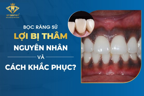 Bọc Răng Sứ Bị Đen Nướu Là Do Đâu【BS.Tư Vấn】