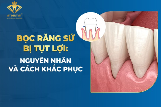 Bọc Răng Sứ Bị Tụt Lợi Là Do Đâu【BS.Chia Sẻ】