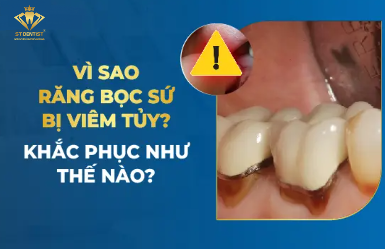 Bọc Răng Sứ Bị Viêm Tủy Là Do Đâu【BS.Tư Vấn】